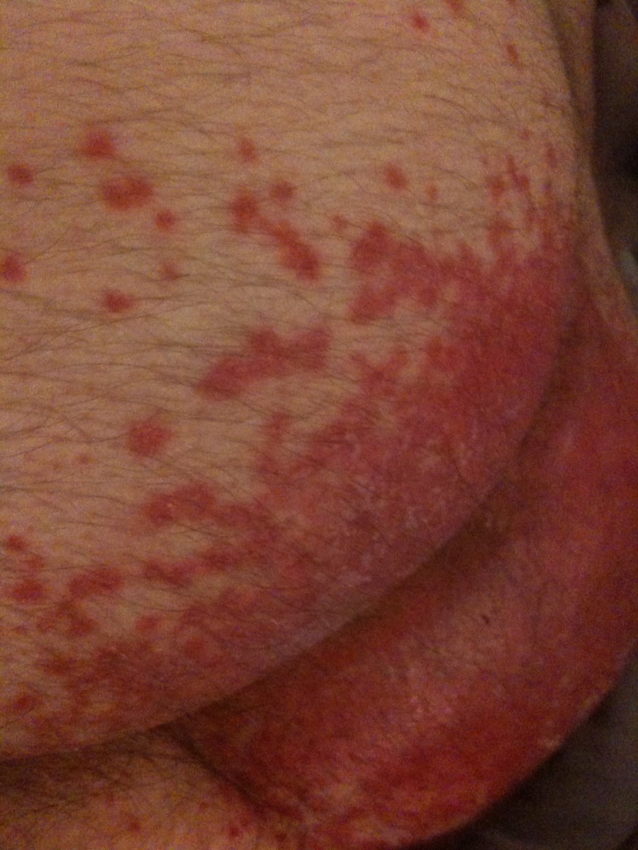 Rash on Buttocks - Dermatology - MedHelp