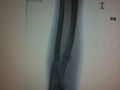 Arm Fracture